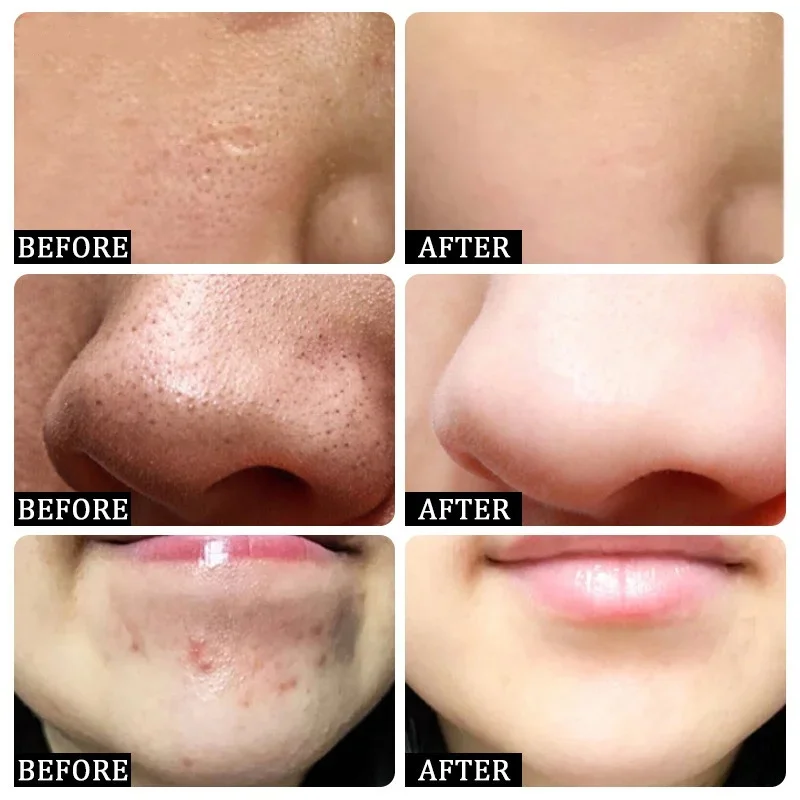 Ácido salicílico poros limpeza - Salicylic Acid Blackhead Remover avaliação e preço